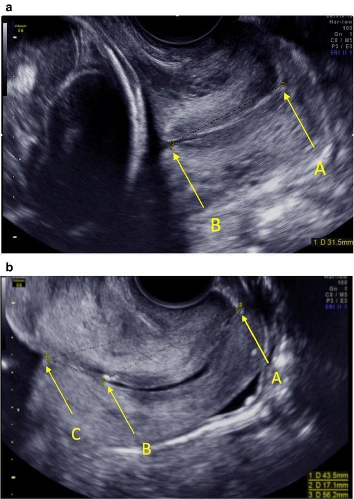 This diagnostic visual consists of two transvaginal ultrasound images (a and b) in the sagittal plane, illustrating methods for measuring cervical length during pregnancy. Image (a) demonstrates a standard measurement when the uterine isthmus is absent; yellow calipers and arrows mark 'A' (external os) and 'B' (internal os), with a linear dotted line representing the endocervical length (31.5 mm). Image (b) displays a scenario where the isthmus is present, introducing a third landmark 'C' designated as the 'virtual inner os.' In this view, distance A-B (43.5 mm) represents the endocervical canal length, B-C (17.1 mm) denotes the isthmus length, and A-C (56.2 mm) represents the total length from the external os to the innermost end of the isthmus. The images highlight key anatomical landmarks used in obstetrics to assess the lower uterine segment and predict preterm birth risk. The hypoechoic endocervical canal and the varying morphology of the internal os region are clearly visualized against the more echogenic cervical stroma.