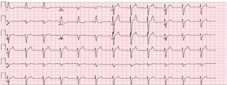 This diagnostic image is a 12-lead electrocardiogram (ECG) demonstrating a sinus rhythm with features characteristic of left ventricular hypertrophy (LVH) and left axis deviation. The limb leads show a predominantly positive QRS complex in Lead I and a predominantly negative QRS complex in Lead aVF, consistent with left axis deviation. In the precordial leads (V1-V6), there is evidence of voltage criteria for LVH, specifically high-amplitude R-waves in the lateral leads (V5 and V6) and deep S-waves in the right precordial leads (V1 and V2). The ST segments and T waves are generally unremarkable across most leads, though there is a slight ST depression and T-wave inversion in the lateral leads, which can be associated with an LVH strain pattern. This tracing serves as an educational example of cardiac remodeling secondary to chronic hypertension or renal disease in a preoperative clinical context.