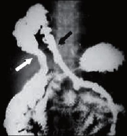 This diagnostic image is a contrast-enhanced fluoroscopic radiograph (barium study) of the upper abdomen and lower thorax, demonstrating a diaphragmatic hernia. The primary finding is the herniation of the transverse colon through a defect in the right dome of the diaphragm into the thoracic cavity. The contrast-filled colon shows a distinct superior deviation from the abdominal cavity. Specifically, the ascending limb of the herniated loop (marked by a white arrow) appears moderately dilated, while the descending portion of the loop passing through the diaphragmatic hiatus (marked by a black arrow) shows relative focal constriction, suggesting the site of the hernia neck. The image illustrates the radiological appearance of a Bochdalek or Morgagni hernia involving the large bowel. This clinical study is essential for visualizing gastrointestinal displacement and assessing the patency of herniated loops in patients presenting with atypical abdominal or respiratory symptoms.