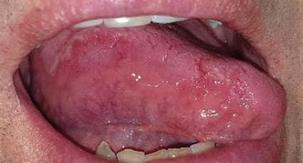 This clinical photograph shows an intraoral view of the tongue, demonstrating classic features of benign migratory glossitis, also known as geographic tongue. The dorsal and lateral surfaces of the tongue exhibit multiple irregular, well-circumscribed erythematous patches. These areas of depapillation appear smooth and glossy due to the loss of filiform papillae. The red lesions are bordered by slightly raised, serpiginous, whitish-yellow margins, creating a characteristic map-like appearance. The surrounding oral mucosa, including the lips and gingiva, appear healthy and pink. The teeth show some slight crowding and yellow-white enamel. The image serves as a high-quality educational example of a common inflammatory condition of the tongue, emphasizing the distinct visual contrast between the smooth atrophic regions and the keratinized borders. Key educational concepts include oral pathology identification, the migratory nature of these lesions, and clinical differentiation from other forms of glossitis or oral candidiasis.