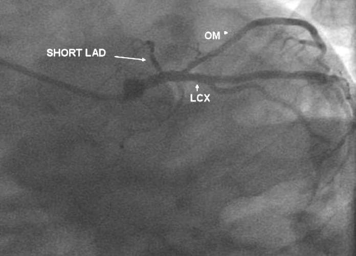 This diagnostic coronary angiogram, captured in a Left Anterior Oblique (LAO) cranial projection, illustrates a congenital coronary anomaly known as Type IV Dual LAD. The image displays the left coronary system following contrast injection. A 'SHORT LAD' (Left Anterior Descending) artery is seen arising from the left main coronary trunk; it is notably truncated, terminating high in the anterior interventricular sulcus and giving rise to small septal branches. Parallel to this, the 'LCX' (Left Circumflex) artery exhibits a normal course, following the atrioventricular groove and giving off a prominent 'OM' (Obtuse Marginal) branch. This visual evidence supports the Spindola-Franco classification of dual LAD systems, where a short LAD originates from the left side and a longer, anomalous LAD (not shown in this specific frame) typically arises from the right coronary artery or right sinus to supply the distal territory. The imaging modality is X-ray fluoroscopy, crucial for interventional cardiology and surgical planning.