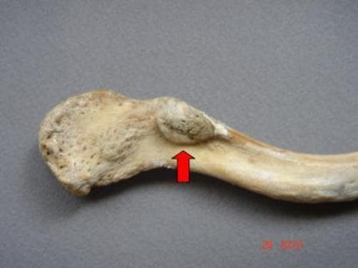 Clinical photograph of a dry bone specimen featuring the inferior surface of the acromial end of a left human clavicle. The visual focus is an anatomical variation: an anomalous clavicular facet for the coracoclavicular joint, indicated by a red arrow. This facet presents as a distinct, triangular bony outgrowth located approximately 5 cm medial to the acromial edge, near the conoid tubercle. The outgrowth's base is attached to the clavicle, with its apex directed inferiorly. The articular surface of the facet appears relatively smooth compared to the surrounding cortical bone, which exhibits a characteristic porous, beige, and slightly rough texture typical of an osteological specimen. This image demonstrates a diarthrotic coracoclavicular joint, a rare anatomical variant that can be clinically relevant in cases of shoulder pain or restricted range of motion. The photograph is intended for educational use in gross anatomy, orthopedics, and osteology to illustrate variations in the coracoclavicular syndesmosis.