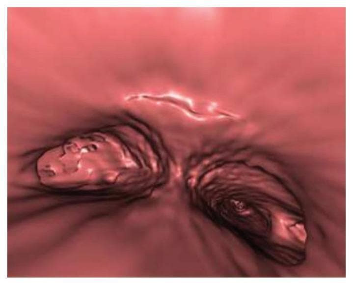 This diagnostic image is a virtual bronchoscopy reconstruction of the tracheobronchial tree, specifically focusing on the bifurcation and the left main bronchus. The reconstruction visualizes the internal luminal surface in a 3D perspective. In the left main bronchus, linear, thin, fenestrated membranes are visible, creating a web-like structure that partially occludes the lumen. Distal to these membranes, there is an area of soft tissue density, which contextually represents the left bronchial stump following a prior pneumonectomy. This density consists of collapsed lung parenchyma or scar tissue and possible suture material. Crucially, the virtual reconstruction demonstrates an intact bronchial stump with no evidence of a bronchopleural fistula (BPF). The image serves as an educational example of post-surgical anatomical changes and the use of non-invasive virtual bronchoscopy (derived from high-resolution CT) to evaluate airway patency and rule out complications like BPF in post-pneumonectomy patients.