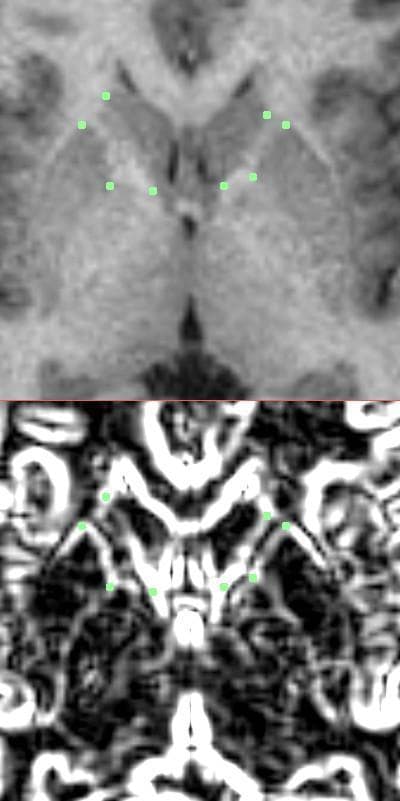 This diagnostic image demonstrates a neuroimaging segmentation protocol for the internal capsule using magnetic resonance imaging (MRI). The figure is divided into two panels: the top panel shows an axial T1-weighted enlarged view of the basal ganglia region, featuring the caudate nucleus, putamen, and the anterior limb of the internal capsule. Manual landmarks (green dots) are placed at four strategic corners to delineate the polygon of the internal capsule: the lateral anterior and posterior aspects of the caudate nucleus, and the medial anterior and posterior aspects of the putamen. The bottom panel displays the same anatomical section processed with a Sobel gradient filter. This edge-detection algorithm enhances the contrast between the gray matter of the striatum and the white matter of the internal capsule, facilitating more precise landmark placement by highlighting the boundaries of the anatomical structures. This method is utilized in clinical research, such as studies on schizophrenia, to quantify volumes and tract lengths in subcortical brain regions.