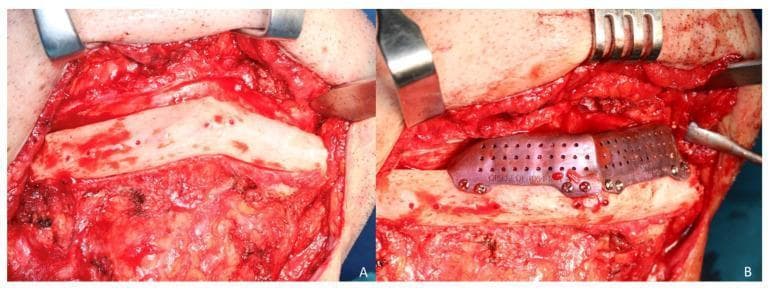 Clinical photograph of an intraoperative maxillofacial reconstruction procedure using a fibula free flap. Figure A shows the surgical exposure of a two-segment fibula flap via a cervical approach. The bone appears pale white with visible surface punctate bleeding, indicating healthy vascularization, and is surrounded by dissected cervical soft tissue and muscle. Figure B demonstrates the placement of a secondary cortico-cancellous iliac crest graft on top of the fibula segments to increase mandibular vertical height. The graft is secured using a custom CAD/CAM titanium mesh, which features a perforated design with 1.5 mm pores to facilitate tissue ingrowth and vascularization. The mesh is fixed to the underlying bone segments with several small diameter (1.5 mm) osteosynthesis screws. This image illustrates complex reconstructive surgery for mandibular defects, specifically addressing vertical discrepancy after primary fibula flap reconstruction.