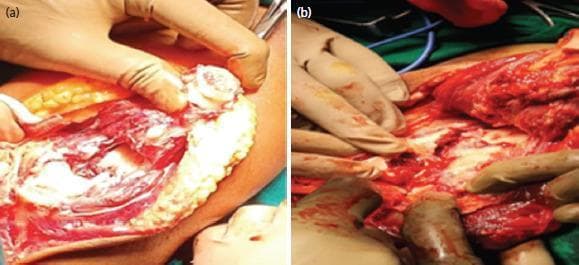 Two intra-operative clinical photographs demonstrating a surgical exposure of the distal humerus via an olecranon osteotomy using a Gigli saw. Panel (a) shows the immediate post-osteotomy state where the proximal olecranon fragment and the triceps extensor mechanism have been retracted to reveal the whitish-yellow articular surface of the distal humerus. The surgical field displays exposed reddish muscular tissue and yellow subcutaneous adipose tissue. Panel (b) illustrates the active manipulation and further dissection of the humerus for fracture visualization. Gloved hands are seen retracting the soft tissues and mobilizing the bone fragments. The images highlight a posterior approach to the elbow joint, a common technique for managing complex intra-articular distal humerus fractures to achieve anatomical reduction of the articular surface. The surgical field is moist and contains moderate blood typical of orthopedic procedures involving significant bone and soft tissue exposure.