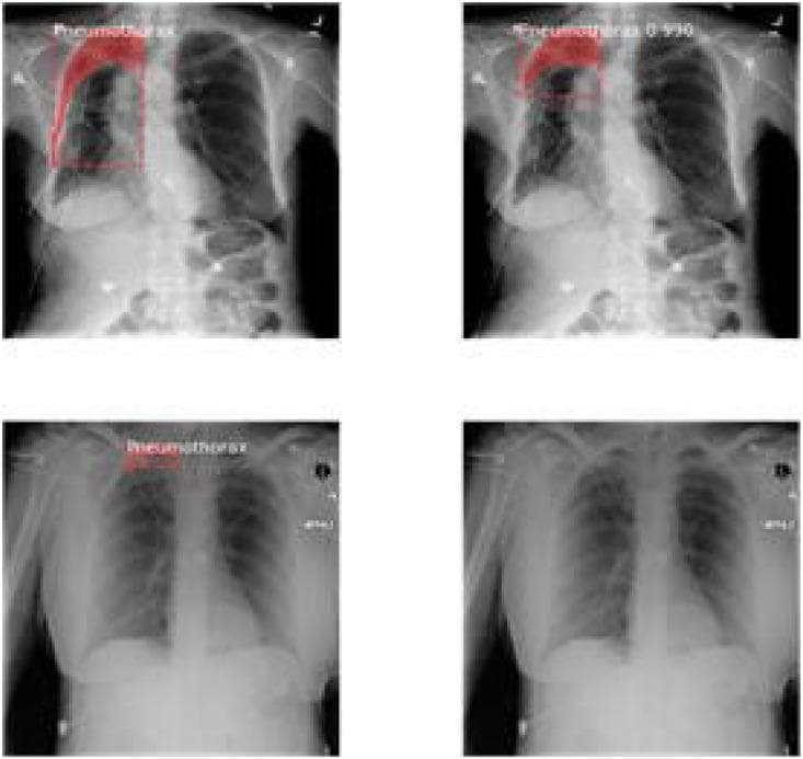 A comparison chart featuring four diagnostic images of posteroanterior (PA) chest radiographs. The visual focus is on the detection and localization of a pneumothorax in the right lung apex. Three of the images demonstrate the application of computer-aided detection (CAD) or artificial intelligence (AI) overlays, showing red-tinted masks and bounding boxes to highlight the apical pleural line and underlying air space indicative of lung collapse. Labels such as 'Pneumothorax' and 'Pneumothorax 0.930' represent prediction scores and classification results. The fourth image is a baseline unannotated radiograph for clinical comparison. Anatomical landmarks including the mediastinum, cardiac silhouette, diaphragm, and clavicles are visible, though the primary educational objective is demonstrating automated localization of pathology. This material serves as an example of medical imaging technology and radiology informatics, illustrating how segmentation and classification algorithms assist in identifying pleural space disorders.