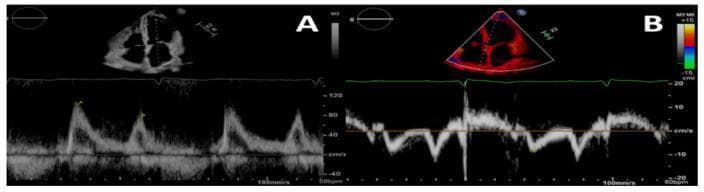 This diagnostic echocardiogram comparison demonstrates two primary modalities used to assess cardiac diastolic function. Panel A features Pulsed-Wave (PW) Doppler imaging of mitral inflow. The top section shows a grayscale B-mode apical four-chamber view, while the bottom section displays a spectral Doppler waveform. The waveform reveals a tall 'E' wave and a smaller 'A' wave, with the E/A ratio and deceleration time suggesting a grade II (pseudonormal) diastolic dysfunction pattern. Panel B displays Tissue Doppler Imaging (TDI) of the left ventricular basal septum. The B-mode image includes a superimposed color Doppler sector highlighting myocardial tissue velocity. The corresponding spectral waveform below shows lower-velocity signals representing myocardial wall motion (s', e', and a' waves). The integration of PW Doppler inflow velocities (E) from Panel A and TDI annular velocities (e') from Panel B allows for the calculation of the E/e' ratio, a critical clinical marker for estimating left ventricular filling pressures in patients with chronic kidney disease (CKD) and suspected uremic cardiomyopathy.