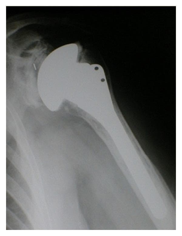 This diagnostic x-ray radiograph demonstrates a total shoulder arthroplasty (TSA). The imaging shows the proximal humerus, glenohumeral joint space, and partial scapula. The humeral component consists of a highly radiopaque metallic intramedullary stem securely positioned within the humeral shaft and a smooth, rounded prosthetic humeral head replacing the original anatomical head. Key features include the surgical replacement of the articulating surface and the visibility of orthopedic hardware, such as suture holes or screw fixations on the proximal portion of the prosthesis. The prosthetic head articulates with the glenoid fossa of the scapula, where a polyethylene glenoid component (often radiolucent but indicated by the joint spacing) is typically placed in a total arthroplasty. This image serves as a clinical example of the surgical management for advanced glenohumeral osteoarthritis, illustrating the interface between metallic implants and native bone structure for orthopedic educational purposes.