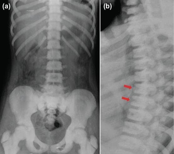 Diagnostic imaging series comprising (a) an anteroposterior and (b) a lateral radiograph of the thoracolumbar spinal column and pelvis. The images demonstrate diffuse, generalized osteosclerosis, marked by a significant increase in bone density throughout the axial skeleton, ribs, and proximal femurs. In the lateral view (b), red arrows highlight the 'sandwich vertebrae' sign, characterized by dense, sclerotic bands at the superior and inferior endplates of the vertebral bodies with relatively lucent central regions. This radiological appearance is also known as 'rugger jersey spine' and is a hallmark of hereditary metabolic bone diseases such as osteopetrosis (Albers-Schönberg disease). The AP view confirms the loss of normal corticomedullary differentiation in the pelvis and long bones. These findings illustrate impaired osteoclast function resulting in failure of normal bone resorption and remodeling.