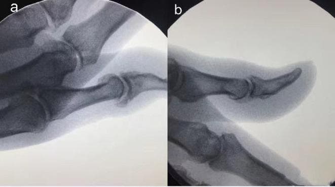 This diagnostic comparison contains two lateral X-ray views of the thumb distal interphalangeal (DIP) joint, demonstrating the surgical management of osteoarthritis. Image (a) represents the pre-operative state, showing significant dorsal osteophyte formation at the DIP joint. These osteophytes appear as radiopaque, irregular bony protrusions along the joint margin, accompanied by joint space narrowing characteristic of advanced degenerative arthritis. Image (b) shows the post-operative result three months following surgical intervention. The previously noted osteophytes have been removed, resulting in a significantly smoother and more regular cortical contour of the distal and middle phalanges at the articulation site. The clinical focus of this visual is to illustrate successful surgical debridement of hypertrophic bone in the context of symptomatic hand arthritis. The imaging facilitates education on identifying radiological signs of osteoarthritis (osteophytosis and joint space loss) and assessing post-surgical anatomical remodeling.