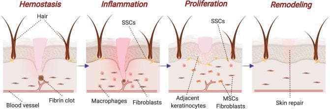 A pathophysiology diagram illustrating the four chronological stages of skin wound healing: Hemostasis, Inflammation, Proliferation, and Remodeling. The visual depicts a cross-section of the integumentary system including the epidermis, dermis, hair follicles, and vasculature. 1) Hemostasis: Shows a fibrin clot formation at the site of vascular injury to stop bleeding. 2) Inflammation: Characterized by the presence of macrophages for phagocytosis and fibroblasts beginning to migrate into the wound site; skin stem cells (SSCs) are indicated near the hair follicles. 3) Proliferation: Displays the migration and activity of adjacent keratinocytes, mesenchymal stem cells (MSCs), and fibroblasts to form a provisional extracellular matrix. 4) Remodeling: Demonstrates the final 'skin repair' phase where tissue integrity is restored, collagen fibers are realigned, and the wound site is closed. This diagram serves as an educational tool for medical students to understand the cellular and structural progression of cutaneous tissue repair.