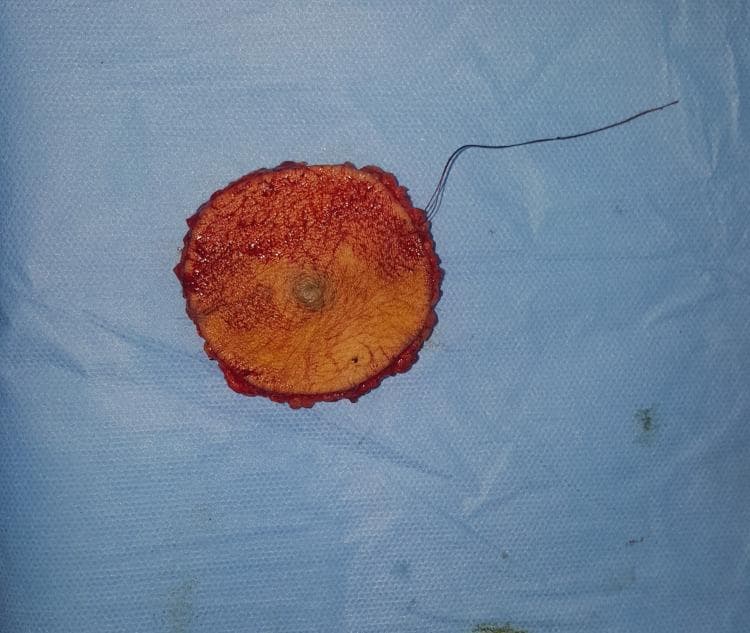 This surgical specimen photograph depicts a wide local excision of a skin lesion, contextually identified as a nodular melanoma. The specimen is roughly circular (discoid), consisting of a central skin island surrounded by deep soft tissue margins. The epidermal surface shows a distinct, centrally located, slightly raised, and pigmented nodule. The surrounding skin surface is tan with fine hair visible, while the peripheral surgical margins are erythematous and irregular, composed of subcutaneous adipose and connective tissue. A long, dark surgical suture is attached to the superior-right margin, serving as an orientation marker for pathological processing. This image illustrates the gross morphology of a radical resection aimed at achieving clear oncological margins for a high-thickness (Breslow 8mm, Clark Level V) malignant melanoma. The specimen is placed on a blue sterile surgical drape, highlighting the immediate postoperative context in a surgical oncology setting.