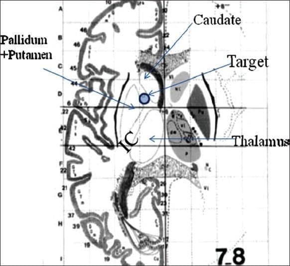 This anatomical diagram represents a stereotactic map of the human brain in the axial plane, specifically illustrating the target site for anterior capsulotomy or deep brain stimulation (DBS) in the treatment of refractory obsessive-compulsive disorder (OCD). The diagram highlights the anatomical relationships between key basal ganglia structures and the internal capsule (IC). The 'Target' is identified as a blue circular area situated within the anterior limb of the internal capsule. Its boundaries are clearly labeled: it is positioned inferior to the head of the caudate nucleus, medial to the pallidum and putamen complex, and superior to the thalamus. The image illustrates the interruption of frontothalamic connections where they converge between the caudate and the putamen. The grid-like overlay indicates stereotactic coordinates used in neurosurgical planning to ensure precise localization for lesioning or electrode placement. This educational visual is relevant for neurosurgery and psychiatry, demonstrating the surgical anatomy of the corticostriatothalamocortical loop.