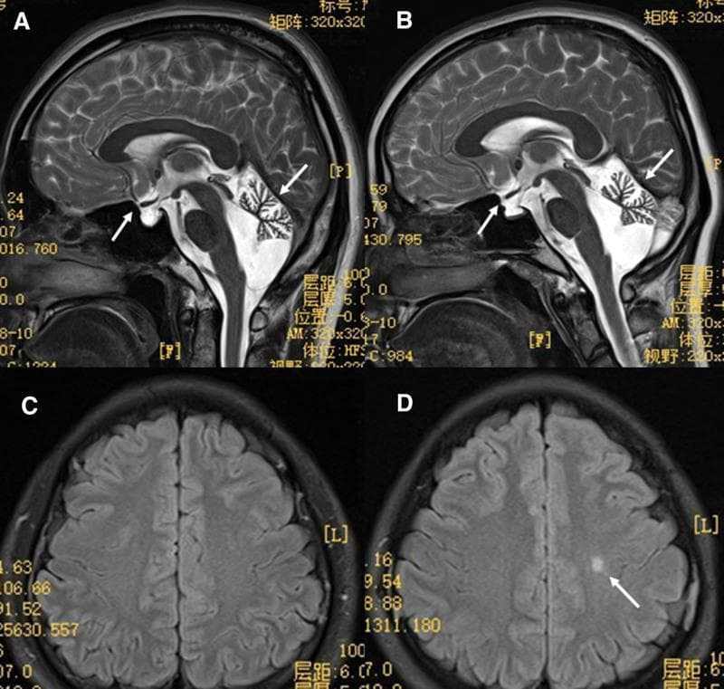 This composite brain MRI displays diagnostic images from two siblings with 4H leukodystrophy (Hypomyelination, Hypodontia, and Hypogonadotropic Hypogonadism). Panels A and B are sagittal T2-weighted images showing prominent cerebellar atrophy, characterized by enlarged sulci and reduced folial volume (white arrows, right). Both siblings also exhibit hypophysis (pituitary) dysplasia, with an abnormally small or flattened pituitary gland visible in the sella turcica (white arrows, left). Panels C and D are axial FLAIR MRI sequences evaluating white matter integrity. Panel C (brother) shows relatively normal signal intensity. Panel D (sister) reveals a focal hyperintense lesion (white arrow) indicating local demyelination or hypomyelination within the subcortical white matter. These imaging findings are classic neuroradiological hallmarks of POLR3B-related leukodystrophy, illustrating the characteristic combination of neurodegenerative changes (cerebellar atrophy) and developmental defects (pituitary dysplasia and myelin deficiency).