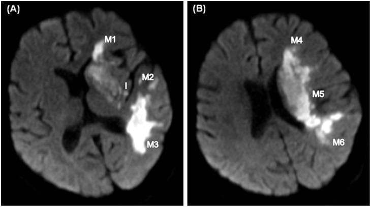 This diagnostic imaging set consists of two axial Diffusion-Weighted Imaging (DWI) MRI scans of the brain (A and B) demonstrating acute ischemic stroke. The images utilize the Alberta Stroke Program Early CT Score (ASPECTS) topographic system to map the extent of cerebral infarction within the Middle Cerebral Artery (MCA) territory. Image A, at the level of the basal ganglia, shows significant hyperintense signals (diffusion restriction) involving the insula (labeled 'I'), lentiform nucleus, internal capsule, and the M1, M2, and M3 cortical zones. Image B, at the suprabasal ganglion level, reveals contiguous infarct expansion into the M4, M5, and M6 cortical regions. The extensive hyperintensity across these zones indicates a large-territory MCA infarction. This clinical example serves as a teaching tool for neuroradiological assessment of stroke severity, infarct growth monitoring, and the application of standardized anatomical labeling (M1-M6) in acute stroke management.
