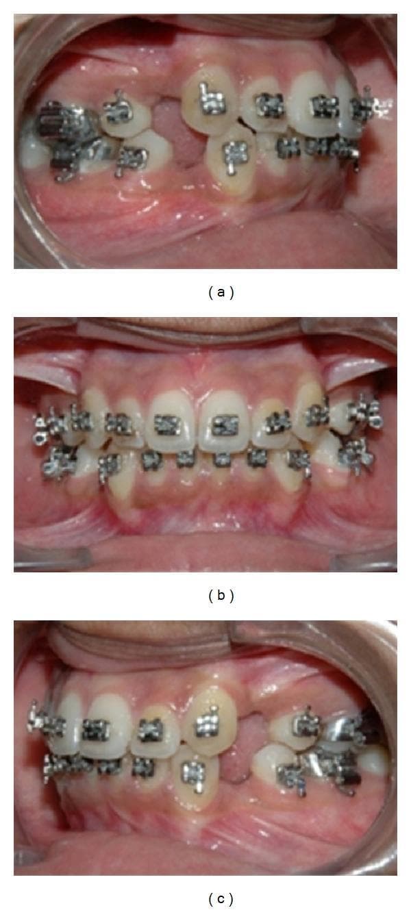 This composite of three intraoral clinical photographs demonstrates the 'alignment and leveling' phase of orthodontic treatment in a patient with bimaxillary protrusion. (a) Right lateral view showing 0.018 pre-adjusted edentulous (PEA) brackets and a continuous archwire. A significant extraction space is visible where the first premolar was removed. (b) Frontal view showing the maxillary and mandibular arches with brackets bonded to the labial surfaces. The teeth exhibit improved but incomplete alignment, with some persisting rotations. (c) Left lateral view showing a corresponding extraction space in the first premolar region. Standard metal brackets are present on the anterior teeth and premolars, while molar tubes are visible on the posterior teeth to provide anchorage. The images illustrate the clinical state after initial leveling, prior to the initiation of 'en-masse' retraction and space closure using sliding mechanics. The gingival tissue appears healthy, and the archwires are engaged with ligatures to facilitate tooth movement along the dental arch.