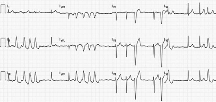 A multi-lead diagnostic electrocardiogram (ECG) rhythm strip illustrating complex cardiac arrhythmias. The baseline rhythm shows atrial fibrillation, characterized by an irregularly irregular ventricular rate and the absence of discernible, consistent P waves. Superimposed on this baseline is a run of nonsustained ventricular tachycardia (NSVT). The wide-complex tachycardia morphology demonstrates a left bundle branch block (LBBB) pattern, evident by the predominantly negative QRS deflection in leads V1 through V3 and a late QRS transition occurring around lead V4. The inferior leads (II, III, and aVF) show a positive QRS axis, indicating an inferior axis. These visual findings—LBBB morphology with an inferior axis and late transition—are clinically suggestive of an arrhythmia originating from the right ventricular outflow tract (RVOT). The T waves exhibit secondary repolarization changes, including inversions in leads with positive QRS complexes. This ECG serves as an educational example of identifying ventricular tachycardia origin sites based on QRS morphology and axis transition in the precordial leads.