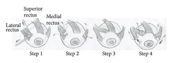 A four-step surgical diagram illustrating the Augmented Partial Rectus Muscle Transposition (APRMT) combined with horizontal muscle recession-resection, specifically for treating superior rectus muscle paralysis. Step 1 shows the longitudinal splitting (division) of the medial rectus and lateral rectus muscles into upper and lower halves. Step 2 depicts the shortening of the upper halves of both muscles using sutures. Step 3 illustrates the transposition of these shortened upper muscle segments to the nasal and temporal aspects of the superior rectus insertion point. Step 4 demonstrates the final stage involving the recession and resection of the remaining lower halves of the medial and lateral rectus muscles to correct concomitant horizontal strabismus. The diagram highlights anatomical relationships between the extraocular muscles on the globe and the specific surgical manipulations of muscle splitting, shortening, transposition, and recession-resection used in complex strabismus management.