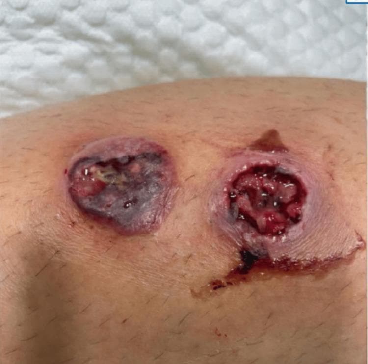 Clinical photograph of two distinct, rapidly progressive skin ulcers on a patient's lower extremity. The lesion on the left is a well-circumscribed, roughly circular ulcer featuring a central area of dark necrotic eschar and peripheral purpuric discoloration. Yellowish fibrinous exudate is visible within the wound bed. The lesion on the right demonstrates a deeper, punched-out ulcerative morphology with irregular, ragged borders and an erythematous, edematous rim. Its base contains raw red granulation tissue, areas of necrosis, and visible serosanguinous fluid streaking inferiorly. Both lesions are approximately 3 to 4 cm in diameter and exhibit signs of severe tissue breakdown and localized inflammation. This visual presentation is characteristic of necrotizing soft tissue infections or aggressive ulcerative conditions such as ecthyma gangrenosum, requiring urgent diagnostic evaluation for underlying pathogens or systemic involvement.