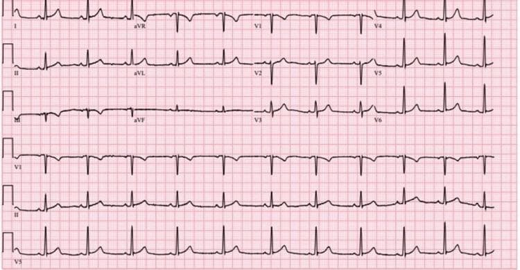 A standard 12-lead electrocardiogram (ECG) displayed on a typical red grid background. The tracing demonstrates a normal sinus rhythm with regular RR intervals. The limb leads (I, II, III, aVR, aVL, aVF) show upright P waves in lead II and inverted P waves in aVR, consistent with sinus origin. The QRS complexes are narrow and exhibit normal morphology across all leads. The precordial leads (V1-V6) show normal R-wave progression from V1 through V6. There is no evidence of acute ST-segment elevation or depression, nor are there any significant T-wave inversions. Rhythm strips for leads VI, II, and V5 are provided at the bottom, confirming rhythm stability. The ECG is clinically significant for its lack of acute ischemic changes despite the patient's elevated troponin levels, illustrating a case of cocaine-induced myocardial injury without diagnostic ST-T wave abnormalities on the initial electrocardiogram.