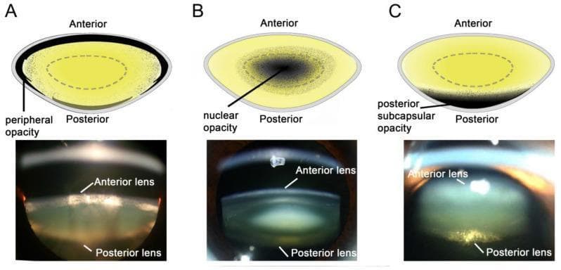 Educational comparison of the three primary types of human cataracts, presented via schematic diagrams (top) and corresponding Scheimpflug slit-lamp photographic images (bottom). The visual is organized into three panels: (A) Cortical cataract, showing characteristic wedge-shaped or peripheral opacities that originate at the lens equator and extend toward the center, often associated with diabetic osmotic stress. (B) Nuclear cataract, demonstrating central densification and opacification within the lens nucleus, typically linked to age-related oxidative protein damage. (C) Posterior subcapsular cataract (PSC), illustrating a localized plaque-like opacity at the posterior pole of the lens just beneath the capsule, frequently associated with corticosteroid use or diabetes. Each schematic identifies the anterior and posterior orientations and highlights the specific zone of lens clouding. The clinical photographs provide a cross-sectional view of the lens, with labels indicating the anterior and posterior lens surfaces, allowing for visualization of the depth and distribution of light scattering within the crystalline lens structure.
