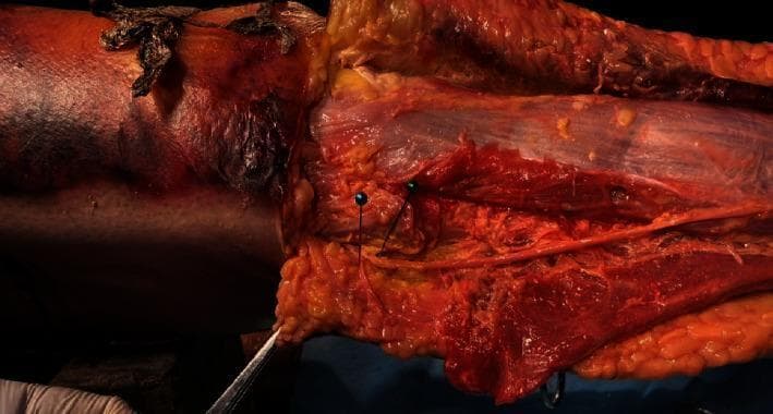 This clinical photograph displays a fresh cadaveric dissection of the lateral compartment of the human lower leg, focusing on the neurovascular and muscular relationships near the fibular head. The image shows the peroneus longus muscle with its characteristic striated reddish tissue and overlying translucent fascia. A critical anatomical feature demonstrated is the bifurcation of the common peroneal nerve. The superficial peroneal nerve is visible running along the muscle belly, while the deep peroneal nerve is shown branching almost perpendicularly to the long axis of the peroneus longus tendon. Two metallic surgical pins are inserted as landmarks to highlight these specific nerve branches and their proximity to the muscle. Surrounding tissues include yellow lobulated subcutaneous fat and reflected skin edges. This anatomical study is relevant for surgical procedures involving peroneus longus tendon harvesting, illustrating the potential risk zones for iatrogenic injury to the deep peroneal nerve branch.