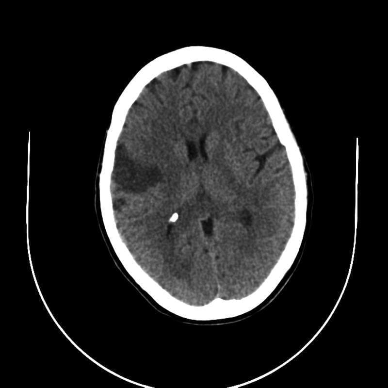 This diagnostic image is an axial non-contrast CT scan of the brain, rather than MRI as some tags suggest, displaying acute to subacute ischemic changes. The primary finding is a moderately sized, wedge-shaped area of hypodensity in the right cerebral hemisphere, corresponding to the vascular territory of the middle cerebral artery (MCA). This hypodense region involves the cortical ribbon and subcortical white matter, indicative of a cytotoxic edema and infarction. A secondary, smaller, and more subtle area of hypodensity is observed in the left MCA territory, suggesting bilateral involvement. Key anatomical landmarks include the hyperdense skull, cerebral sulci, and the ventricular system, which shows slight compression or effacement adjacent to the larger infarct site. The image illustrates the classic radiological presentation of ischemic stroke in the MCA distribution, serving as a critical educational example for identifying vascular territory infarcts and associated tissue density changes in neuroimaging.