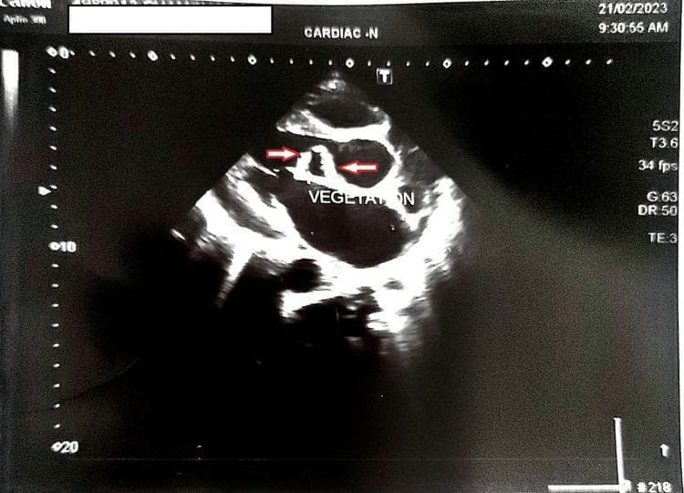 Diagnostic Image: This clinical echocardiogram shows a transthoracic parasternal long-axis view of the heart. Two red arrows and a text label point to 'VEGETATION' located on the aortic valve leaflets. The vegetations appear as small, irregular, and heterogeneous masses with mixed echogenicity (containing both hyperechoic and hypoechoic elements) attached to the valvular structure. These findings are characteristic of infective endocarditis, illustrating the presence of friable microbial growths on the heart valves. The imaging highlights the typical morphology and location of valvular vegetations, which can lead to complications such as aortic regurgitation. This visual is intended for medical education regarding cardiology, infectious diseases, and diagnostic ultrasound interpretation.
