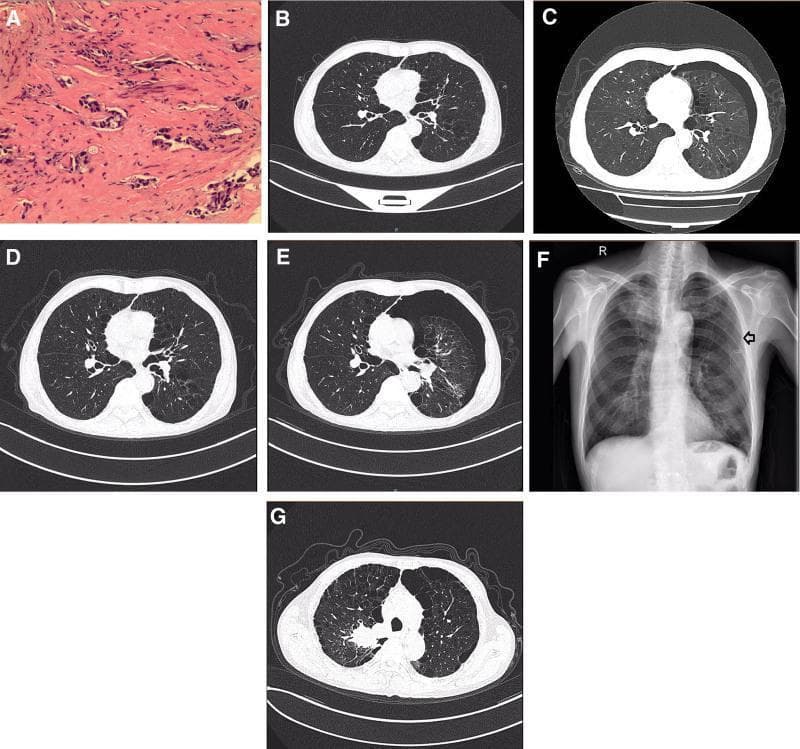 A multi-panel figure illustrating the clinical course of a patient with lung adenocarcinoma and recurring pneumothorax. Panel A displays a histopathological image (H&E stain) showing malignant epithelial cells forming glandular structures, diagnostic of lung adenocarcinoma. Panels B-E and G are axial contrast-enhanced chest CT scans in the lung window. Panel B establishes a baseline with clear lung parenchyma. Panels C and E demonstrate a left-sided pneumothorax, characterized by a visible pleural line and an absence of distal lung markings, indicating partial lung collapse. Panel D shows spontaneous resolution/absorption of the air in the pleural space. Panel F is a posterior-anterior (PA) chest X-ray showing the lung re-expanded following the insertion of a closed thoracic drainage tube (chest tube). Panel G displays a follow-up CT scan with stable lung expansion and no recurrent pneumothorax. The series highlights the management and radiological appearance of secondary spontaneous pneumothorax in the context of advanced pulmonary malignancy and tyrosine kinase inhibitor (anlotinib) therapy.