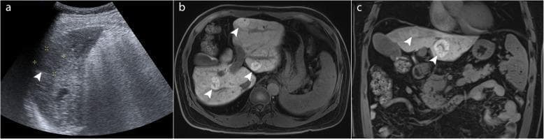 This composite diagnostic image demonstrates the comparative utility of ultrasound and magnetic resonance imaging (MRI) in evaluating liver pathology within a cirrhotic liver. Panel (a) is a B-mode ultrasound image showing heterogeneous, echogenic parenchyma typical of cirrhosis, with a poorly defined hypoechoic lesion (arrowhead) measuring approximately 2–3 cm. The visual detail is limited by acoustic shadowing and coarse texture. Panels (b) and (c) represent axial and coronal gadoxetic acid-enhanced MRI scans, respectively. These cross-sectional images provide superior contrast and spatial resolution, revealing multiple well-demarcated, hyperintense focal nodular hyperplasia (FNH)-like nodules (arrowheads) distributed throughout the liver segments. These benign lesions exhibit characteristic enhancement patterns on the hepatobiliary phase that distinguish them from malignant entities like hepatocellular carcinoma. The comparison highlights the limitations of ultrasound screening in high-risk patients with chronic hepatitis B and cirrhosis, where complex parenchymal changes can obscure numerous benign nodules, necessitating advanced contrast-enhanced imaging for definitive characterization.