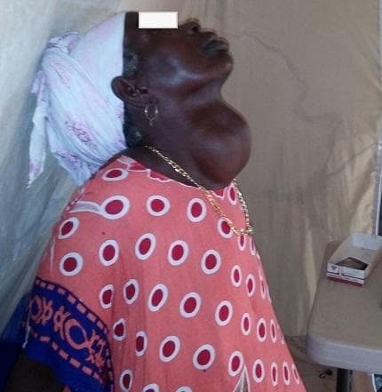 This clinical photograph shows a profile view of a 55-year-old female patient with a massive multinodular goiter (enlarged thyroid gland). The pathology is located in the anterior neck, presenting as a very large, rounded, and protuberant mass that extends symmetrically across both thyroid lobes. The overlying skin appears intact with a smooth texture and no visible ulceration, erythema, or inflammatory changes. The goiter is of such significant volume that it obscures the normal contours of the mandible and neck, and clinically, it was described as mobile without induration. This image illustrates a chronic, severe manifestation of iodine deficiency or benign thyroid disease, common in regions with limited surgical access. The clinical relevance focuses on the diagnostic physical examination of neck masses and the secondary effects of such enlargement, such as tracheal deviation or compressive symptoms. The patient is shown with a head covering and a patterned top, which provides cultural context but does not detract from the clear presentation of the anatomical abnormality.