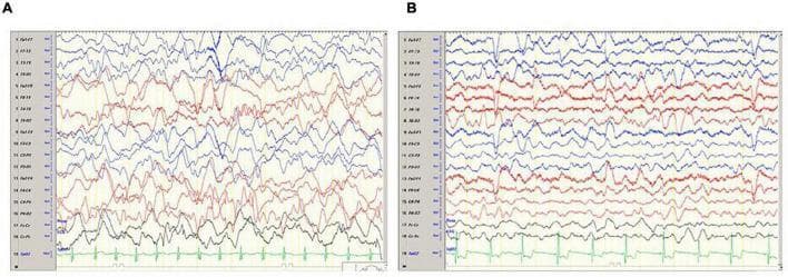 This diagnostic image shows a side-by-side comparison of two longitudinal bipolar montage electroencephalograms (EEG) from a pediatric patient following carbon monoxide (CO) poisoning, illustrating the progression of encephalopathy. Panel A (day 6 post-exposure) displays severe diffuse slowing characterized by high-amplitude delta wave activity (<4 Hz) across all leads, with a lack of normal posterior dominant rhythm and absence of focal or epileptiform discharges. Panel B (day 10 post-exposure) demonstrates clinical and neurophysiological improvement, showing a transition to lower-amplitude, higher-frequency theta waves (4–7 Hz). While some residual delta activity remains, the overall background activity reflects a recovering cortical state. Both panels include a single-lead EKG rhythm strip at the bottom for cardiac monitoring. This comparison serves as a diagnostic tool for monitoring neurological recovery and the severity of toxic-ischemic brain injury in acute CO poisoning cases.