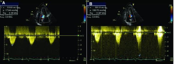 This composite diagnostic image displays two panels (A and B) of a transthoracic echocardiogram utilizing Continuous Wave (CW) Doppler and Color Flow Mapping. The image illustrates the dynamic nature of Left Ventricular Outflow Tract (LVOT) obstruction in a patient with hypertrophic cardiomyopathy. Panel A shows the LVOT gradient at rest following beta-blocker therapy, featuring a rounded Doppler envelope with a peak velocity of 210.0 cm/s and a pressure gradient of 17.64 mmHg. Panel B demonstrates the effect of a Valsalva maneuver, which reduces preload and exacerbates the obstruction. This is visually represented by a characteristic 'dagger-shaped' or late-peaking systolic waveform, showing a significant increase in peak velocity to 501.9 cm/s and a peak pressure gradient of 100.75 mmHg. The upper portions of both panels show the apical four-chamber view with a color Doppler sector placed over the LVOT; Panel B displays more prominent, turbulent (aliased) flow compared to Panel A. This comparison is a classic educational example of dynamic subaortic obstruction provocation during cardiac ultrasound.