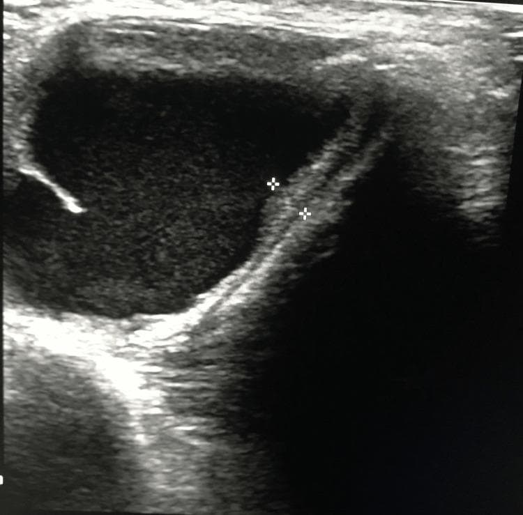 This diagnostic ultrasound image in the transverse plane depicts a large, well-circumscribed thyroglossal duct cyst in the anterior midline of the neck. The cyst is primarily anechoic to hypoechoic, indicating a clear fluid-filled interior, and exhibits smooth, well-defined borders. A key anatomical feature is the presence of an associated thyroglossal tract extending from the cyst wall, which is demarcated by two electronic calipers (plus-sign markers). This tract appears as a linear, moderately echogenic structure extending superiorly toward the hyoid bone region. A small, focal echogenic projection or internal debris is visible along the left inner margin of the cyst. The image demonstrates typical sonographic findings used to diagnose thyroglossal duct anomalies and evaluate their relationship to surrounding midline neck structures, which is essential for pre-surgical planning of a Sistrunk procedure.