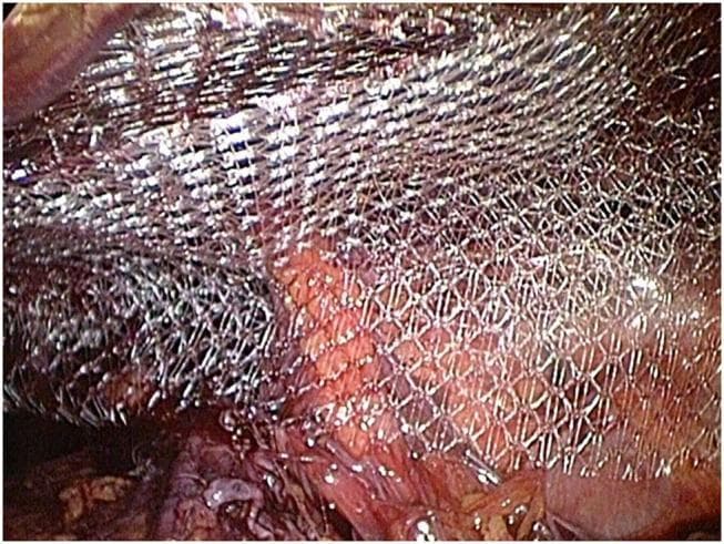 This intraoperative clinical photograph captures a Totally Extraperitoneal (TEP) laparoscopic repair of an inguinal hernia. The central focus is a 15 x 12 cm large-pore monofilament polypropylene surgical mesh (Bard Soft Mesh) being positioned within the preperitoneal space. The mesh exhibits a metallic, silvery-white sheen and a distinct diamond-shaped, porous grid structure designed for optimal tissue integration and pliability. Beneath the semi-transparent mesh, the anatomical landmarks of the inguinal region and Retzius space are visible, specifically showing the reddish-pink vascularized tissue and the underlying musculofascial structures. The image demonstrates the 'double mesh technique' where the prosthetic material is laid over the dissected hernia site without mechanical fixation. This visual serves as a high-level educational example of laparo-endoscopic hernia management, illustrating the proper orientation and coverage of a polypropylene prosthesis over the myopectineal orifice to reinforce the abdominal wall.