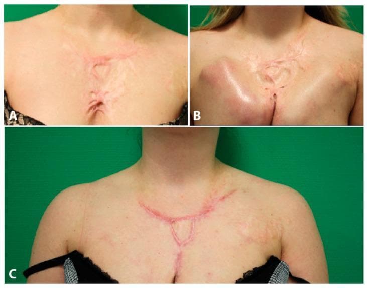 This clinical photograph series illustrates the surgical reconstruction of hypertrophic scarring on the chest and décolleté area of an 18-year-old female patient following burn injuries. Panel A displays the initial presentation of extensive, erythematous hypertrophic scar tissue characterized by thick, raised, branching cords and central tethering. Panel B shows the intermediate stage following tissue expander implantation; a significant subcutaneous volume prominence is visible on the right chest wall, stretching the overlying skin to gain healthy surface area for subsequent reconstruction. Panel C demonstrates the six-month postoperative outcome following scar resection and closure. The final image shows a flattened, significantly reduced linear scar following the natural contours of the décolleté, with improved skin texture and normalized chest wall contour compared to the preoperative state. The series serves as an educational example of plastic surgery techniques for managing complex post-burn contractures using tissue expansion and secondary resection.