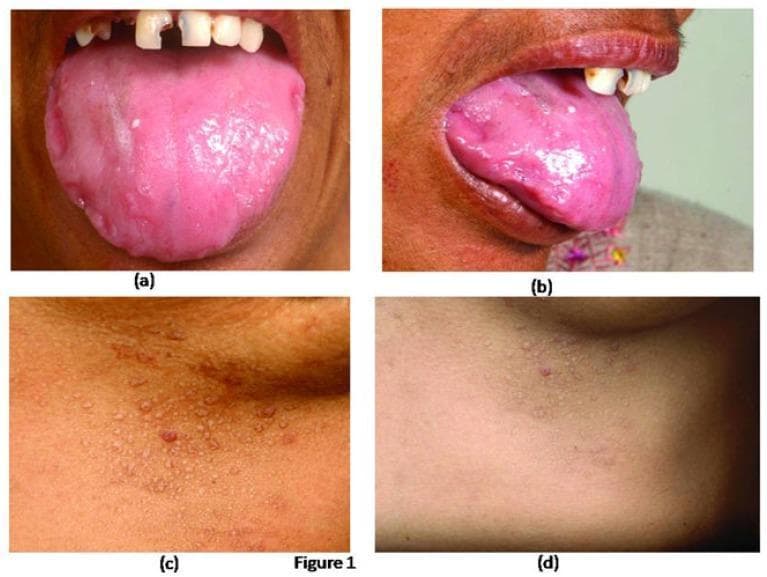 A composite of four clinical photographs demonstrating cutaneous and mucosal manifestations of systemic amyloidosis. Panels (a) and (b) show an intraoral and lateral view of the tongue, exhibiting significant macroglossia (enlargement). The tongue surface is irregular and bumpy, with prominent scalloping (crenation) along the lateral margins caused by indentations from the adjacent teeth. Panels (c) and (d) provide close-up views of the lower chest wall, displaying a dense distribution of small, discrete, waxy, papular lesions. These papules are flesh-colored to slightly erythematous and appear well-circumscribed. These findings represent classic diagnostic signs: macroglossia with dental indentations and characteristic papular amyloid skin deposits. The image is highly relevant for medical education concerning restrictive physiology disorders, plasma cell dyscrasias, and the physical examination of multisystemic protein deposition diseases.