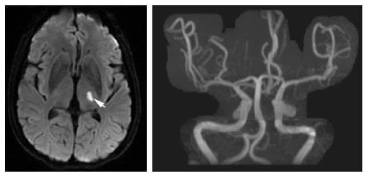 This composite diagnostic image illustrates a case of symptomatic lacunar ischemic stroke. The left panel shows an axial slice Diffusion-Weighted Imaging (DWI) MRI of the brain, featuring a well-circumscribed, hyperintense (bright) lesion. The lesion is located in the left deep white matter, specifically involving the posterior limb of the internal capsule or lateral aspect of the thalamus, indicated by a white arrow. This signal intensity represents restricted diffusion consistent with acute lacunar infarction. The right panel displays a Magnetic Resonance Angiography (MRA) of the intracranial vasculature, including the Circle of Willis and its major branches (middle, anterior, and posterior cerebral arteries). The MRA shows patent vessels with no evidence of large vessel occlusion, high-grade stenosis, or macrovascular disease. Together, these images demonstrate that the infarct resulted from small vessel disease (microatheroma or lipohyalinosis of a single perforating artery) rather than large artery thromboembolism.