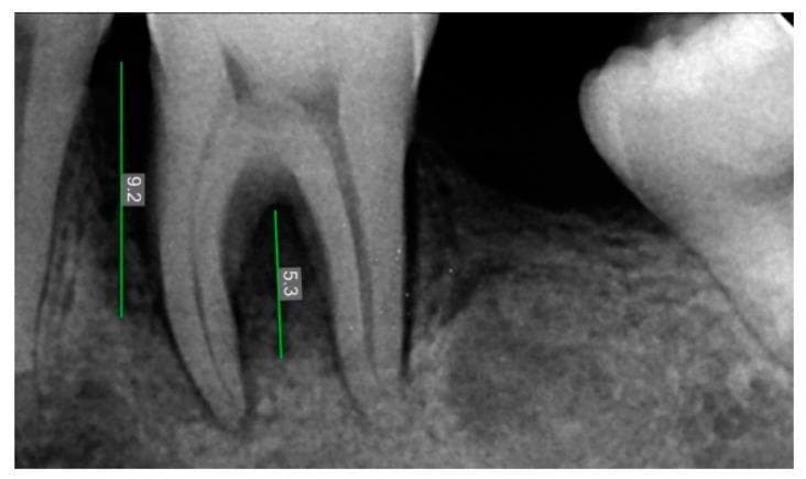 This diagnostic image is a periapical radiovisiography (RVG) radiograph showing the mandibular left first molar (tooth 36) in a pre-operative clinical state. The radiograph demonstrates a significant periodontal bone defect characterized by radiolucency surrounding the mesial and distal roots. Specifically, there is evidence of furcation involvement, where the interradicular bone is diminished. Two vertical measurement lines with digital calipers are visible: one measuring 9.2 units indicating the vertical depth of the mesial osseous defect relative to the cementoenamel junction or bone crest, and another measuring 5.3 units quantifying the height of the furcation defect. The surrounding alveolar bone shows a loss of normal trabecular pattern and increased radiolucency, indicative of inflammatory bone resorption or periodontal disease. The image is intended for dental education regarding the assessment of infrabony defects and the planning of regenerative periodontal therapy.