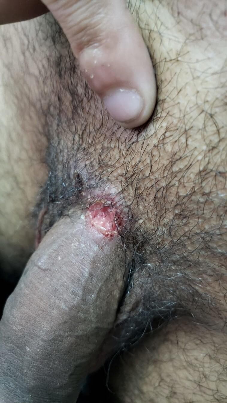This clinical photograph shows a single, well-defined ulcerated lesion located at the base of the penile shaft, near the junction with the pubic region. The lesion is roughly circular with irregular borders and features a raw, erythematous base with a moist appearance, suggesting potential serous exudate. The surrounding tissue demonstrates mild perilesional inflammation and erythema. Anatomically, the site is characterized by overlying pubic hair and standard genital skin architecture. The visual presentation is highly characteristic of a primary syphilis chancre (Treponema pallidum infection), though the context indicates a coinfection with herpes simplex virus type 1 (HSV-1). This image serves as an educational example of genital ulcer disease (GUD) and primary syphilis manifestations in a clinical setting, highlighting the morphology of a syphilitic chancre which is typically firm, indurated, and painless.