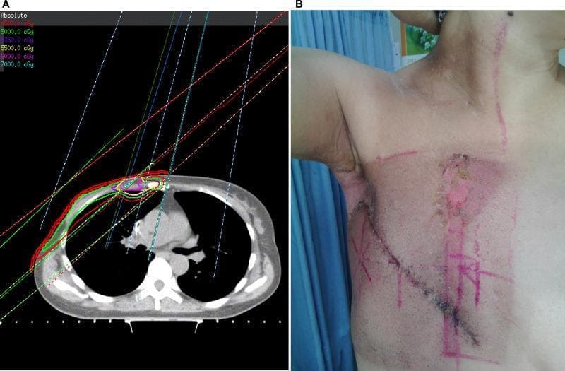 This composite educational graphic illustrates the correlation between radiation therapy planning and acute skin toxicity in a post-mastectomy patient. Image A is a diagnostic axial CT scan of the chest showing a conventional radiotherapy dosage plan for breast cancer. Colored isodose curves (45 Gy to 70 Gy) are superimposed on the anterior chest wall, revealing 'hot spots' where radiation fields overlap between the medial tangent and the internal mammary node (IMN) field. Image B is a clinical photograph of the same patient’s right chest and axilla demonstrating acute radiation dermatitis. Key findings include extensive moist desquamation characterized by denuded, erythematous skin and serous exudate in the axillary fold and the parasternal region. The distribution of the skin lesions corresponds directly to the high-dose 'hot spots' identified in the radiation plan. Clinical markers and surgical scars are also visible, highlighting the spatial relationship between the treatment fields and the resulting cutaneous damage. This visual demonstrates the pathophysiology of radiation-induced skin injury and the clinical significance of dose distribution in oncological treatment.