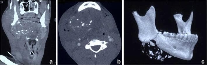 This composite diagnostic image presents a Multi-Detector Computed Tomography Angiography (MDCTA) study of a 16-year-old male with a high-velocity projectile injury to the right neck (Zone 2). Panel (a) is a coronal reformatted image showing a massive hyperdense haematoma in the right submandibular and sublingual spaces, extending laterally into the buccal soft tissues. Panel (b), an axial slice, demonstrates significant soft tissue oedema, haematoma, and bilateral surgical emphysema. Numerous in-driven bone fragments are dispersed within the right-sided soft tissue swelling. Due to severe airway distortion by haemorrhagic debris, a cricothyroidotomy cannula is visible in situ as a life-saving airway intervention. Panel (c) utilizes a 3D Volume Rendering Technique (VRT) to highlight a focal, highly comminuted fracture of the posterior right hemimandible. The 3D reconstruction clearly depicts the fragmentation and inferior dispersal of bone shards resulting from the impact. This case illustrates the utility of MDCTA in assessing complex maxillofacial trauma, secondary projectile damage from bone fragments, and the critical need for emergent surgical airway management in penetrating neck injuries.