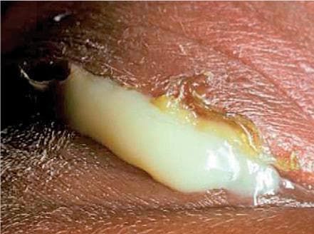 This clinical photograph displays a close-up view of a neonatal eye exhibiting severe ophthalmia neonatorum, likely caused by Neisseria gonorrhoeae infection. The primary visual finding is a massive, hyperacute purulent discharge characterized by a thick, creamy, yellowish-white consistency that is so copious it obscures the underlying globe. The superior and inferior eyelids are markedly edematous (swollen) and erythematous, indicating significant periorbital inflammation. The surrounding skin appears irritated and macerated from contact with the abundant exudate. This presentation is a medical emergency due to the risk of rapid corneal perforation and permanent vision loss. The image serves as a critical educational tool for recognizing the signs of neonatal gonococcal conjunctivitis, emphasizing the urgency of immediate systemic antibiotic treatment and ocular irrigation.
