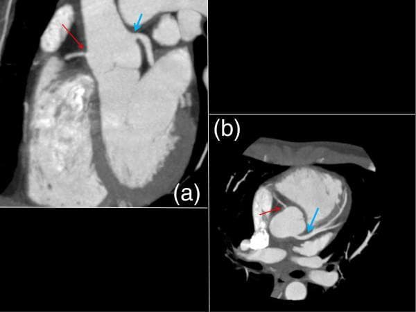 Two images from a cardiac gated CT angiography (CTA) of the chest in coronal (a) and axial (b) planes, demonstrating the coronary artery anatomy following systemic therapy for Takayasu's arteritis. In the coronal view (a), a thin red arrow identifies the right coronary artery (RCA) originating from the aortic root. Although better visualized than on previous imaging, it remains significantly stenotic with a narrowed lumen at the ostium. A blue arrow highlights the left coronary artery (LCA), which shows substantial interval improvement in patency. The axial view (b) provides a cross-sectional perspective of the same vessels, with the red arrow pointing to the persistent narrowing of the RCA ostium and the blue arrow indicating the significantly opened lumen of the LCA. These diagnostic images are used to monitor vascular wall thickening and luminal stenosis in large-vessel vasculitis, illustrating the differential response of the coronary ostia to pharmacological treatment.
