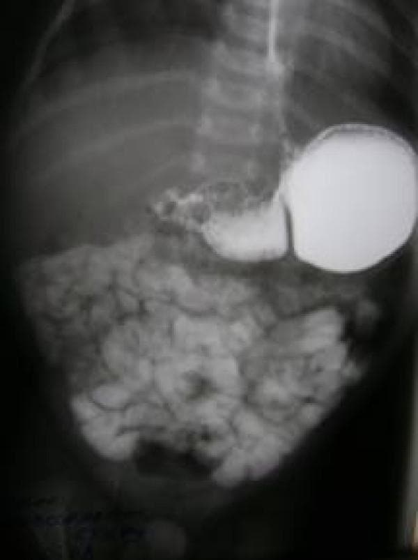 This diagnostic image is an abdominal X-ray from an upper gastrointestinal (GI) contrast study. The radiograph reveals a significantly dilated stomach filled with radiopaque contrast material, exhibiting a 'double loop' appearance or marked gastric distension. A focal, high-grade constriction is visible at the prepyloric region, characterizing a prepyloric stricture. Distal to the site of obstruction, a small amount of contrast has passed into the small bowel, which appears in a clustered pattern. The imaging findings are consistent with gastric outlet obstruction, specifically prepyloric stenosis or stricture, causing delayed gastric emptying. The study highlights the anatomical distortion and proximal dilatation typical of obstructive pathology in the pediatric or adult upper GI tract.
