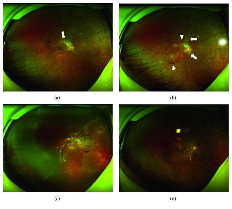 This set of four fundus images (a-d) illustrates the clinical progression of proliferative vitreoretinopathy (PVR) or proliferative diabetic retinopathy over time. Image (a) shows early signs of neovascularization, with fibrovascular proliferation (arrow) near the superior vascular arch. Image (b) demonstrates rapid advancement 4 weeks later, with increased proliferation (arrows) and new retinal hemorrhages (arrowheads). Image (c) displays a severe complication at 9 weeks, characterized by tractional retinal detachment (TRD) and extensive vitreous hemorrhage, obscuring macular details. Image (d) shows the postoperative appearance after vitrectomy, indicating retinal reattachment but significant architectural distortion. The series serves as an educational timeline for medical professionals to identify early vascular proliferation and the catastrophic risks of progression to tractional detachment. Key educational concepts include neovascularization, fibrovascular membranes, vitreoretinal traction, and surgical intervention in advanced retinopathy.