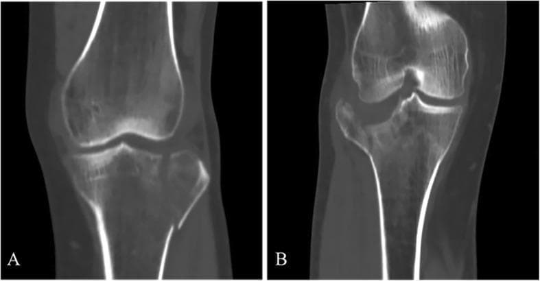 This diagnostic image displays two coronal CT reconstructions of the knee, illustrating different patterns of lateral tibial plateau fractures according to the Schatzker classification system. Image A shows a Schatzker Type I fracture, characterized by a simple vertical split of the lateral tibial condyle without significant depression of the articular surface. The fracture line is clean and extends from the lateral articular margin down into the metaphysis. Image B demonstrates a Schatzker Type II fracture, which consists of a lateral condylar split combined with a central articular depression. This depression is visible as a vertical 'step-off' in the joint surface, indicating a more complex injury mechanism typically involving both axial loading and valgus stress. Both images provide a clear comparison of articular congruity versus displacement, which is essential for determining surgical management. These patterns are common in orthopedic trauma and are critical for medical students and residents to differentiate during radiological assessment of knee injuries.