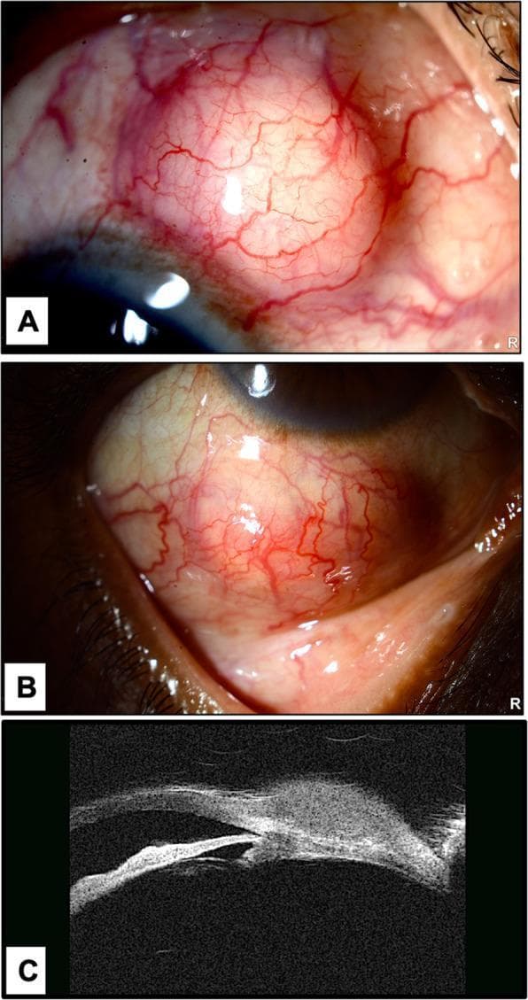 This composite medical image provides a multi-modal clinical and diagnostic evaluation of ocular scleral nodules. Panels A and B are clinical photographs of a right eye showing two distinct, raised, round scleral nodules located in the superior and inferior bulbar regions. The nodules are well-circumscribed and characterized by prominent, dilated episcleral 'feeder' vessels crossing their surfaces, while the surrounding conjunctiva remains relatively white and non-inflamed. Panel C presents an Ultrasound Biomicroscopy (UBM) cross-sectional image of a nodule. The UBM reveals a homogenous, hypo-reflective subconjunctival mass. Notably, the imaging demonstrates localized scleral thinning (scleral melting) beneath the lesion, without evidence of full-thickness perforation. These findings are clinically relevant for the differential diagnosis of infectious scleritis, particularly rare manifestations like Tropheryma whipplei, or inflammatory conditions such as nodular episcleritis. The images serve as an educational resource for identifying ocular mass lesions and the utility of UBM in assessing scleral integrity.