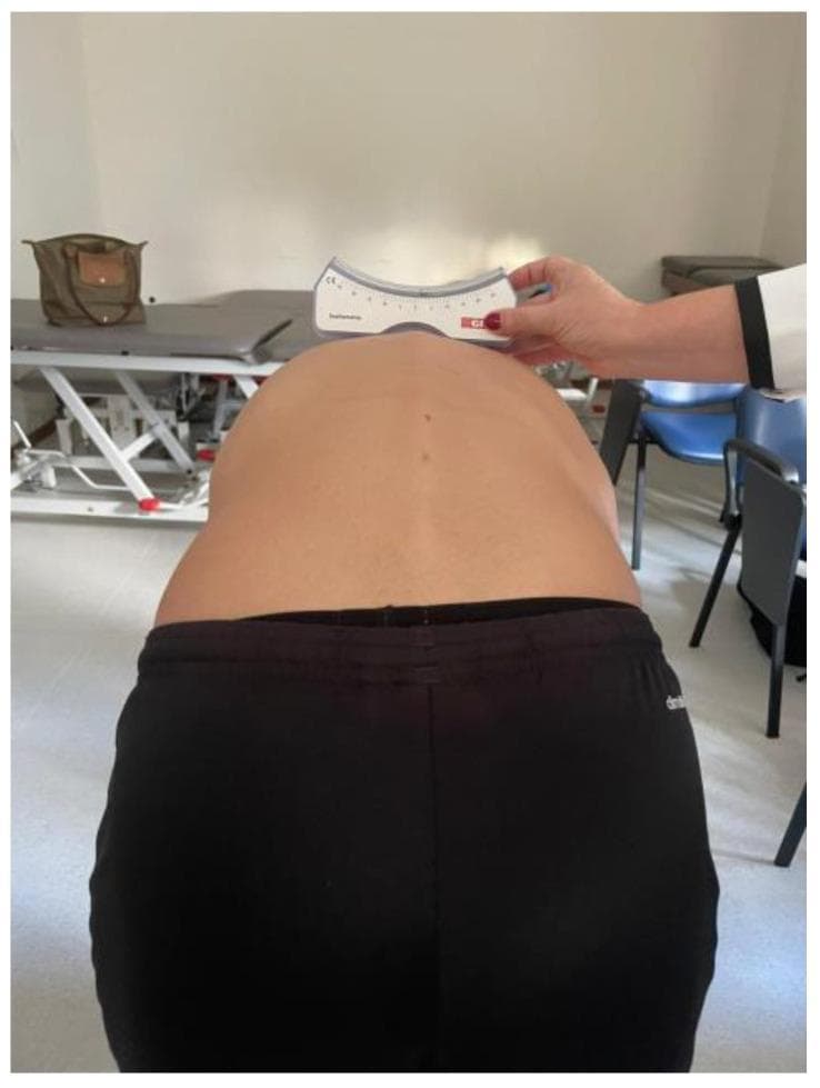 This clinical photograph demonstrates a procedural assessment for scoliosis using a scoliometer during an Adams Forward Bend Test. The image shows the posterior view of a patient's torso in a flexed position, revealing a prominent rib hump and paraspinal muscle asymmetry on the left side of the upper back. A clinician, wearing a white lab coat, is holding a white scoliometer horizontally across the apex of the spinal curvature to measure the Angle of Trunk Rotation (ATR). The scoliometer features a curved base designed to fit over the spinous processes and a graduated scale with black markings and a red indicator to quantify the degree of vertebral rotation. This diagnostic procedure is essential for identifying adolescent idiopathic scoliosis and determining the need for further radiological imaging. The clinical significance of this visual is to illustrate the quantification of trunk asymmetry and postural changes associated with lateral spinal curvature and rotational deformity.